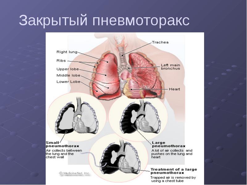 Презентация повреждения грудной клетки