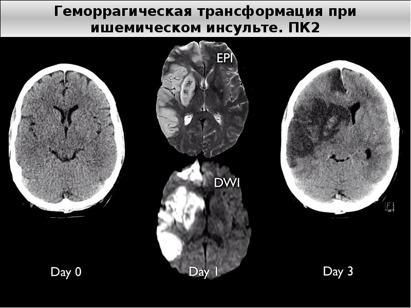 Ишемический инсульт карта