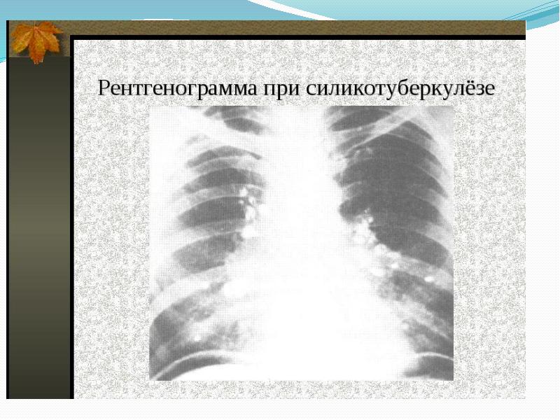 Пневмокониозы рентгенологическая картина