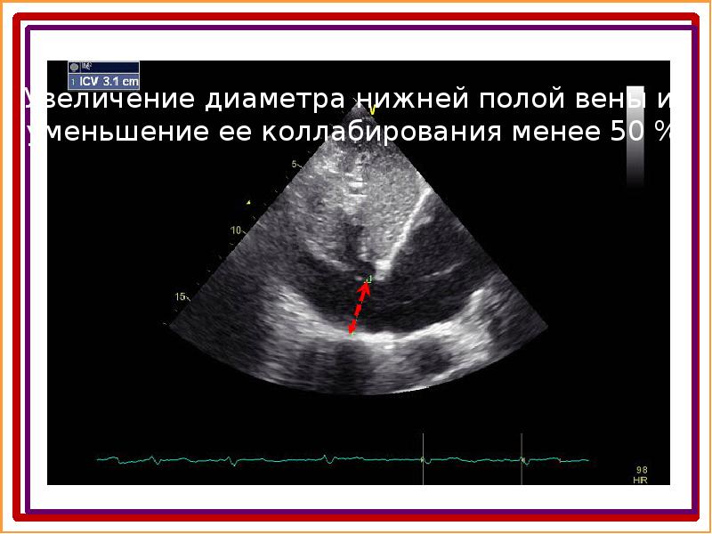 Коллабирование стенки правого предсердия