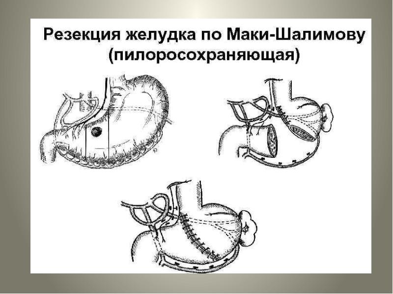 Операция резекция желудка. Резекция желудка по маки Шалимову. Пилоросохраняющая резекция. Пилоросохраняющая резекция желудка по Шалимову. Резекция желудка по Бильрот 1 рентген.