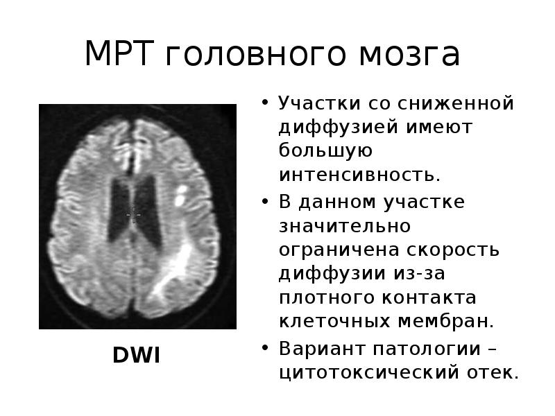 Отек мозга у пожилых причины. Вазогенный отек головного мозга кт. Цитотоксический отек головного мозга кт. Вазогенный отек головного мозга на мрт.