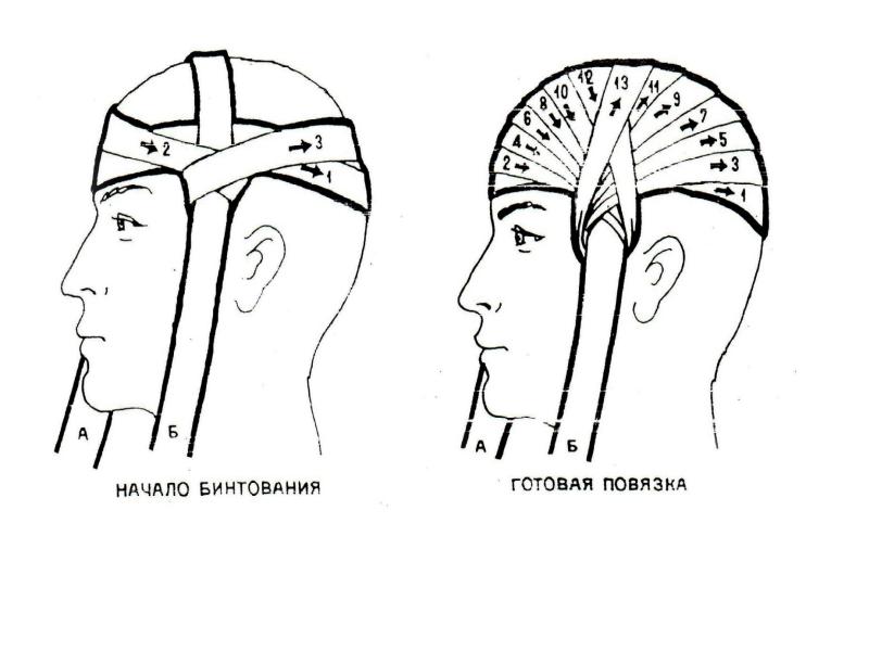 Схема повязки чепец