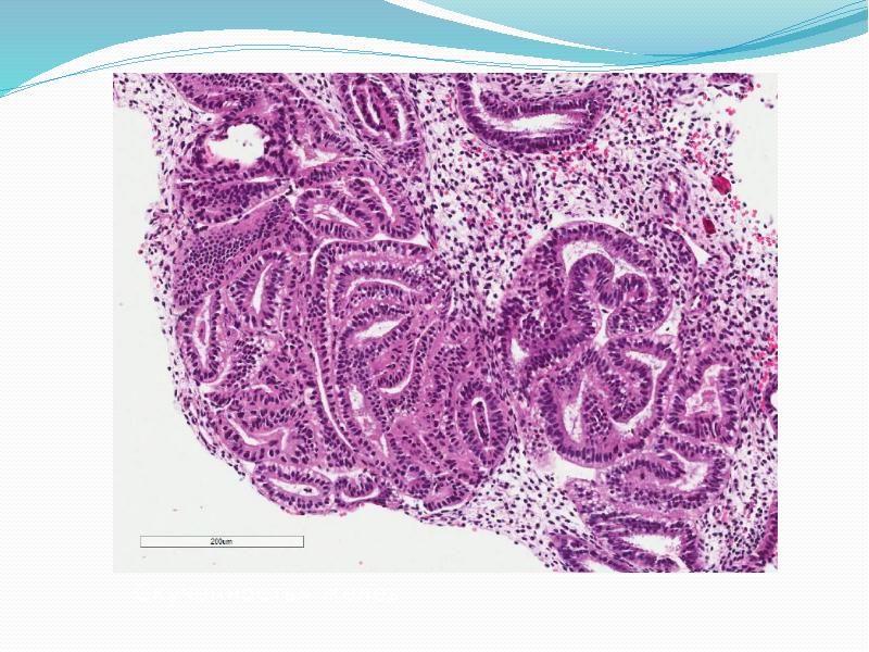 В соскобе фрагменты эндометрия. Аденокарцинома мочевого пузыря гистология. Целиакия гистология кишечника. Ворсинки кишечника при целиакии.