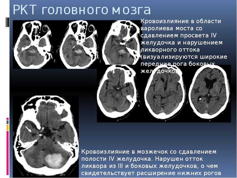 Диффузные изменения головного мозга. РКТ головного мозга. Геморрагический инсульт презентация. Расширение зрачка геморрагический инсульт. Геморрагический инсульт морфология.