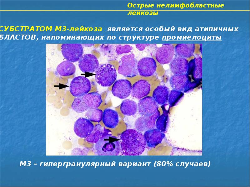 Острый миелолейкоз презентация