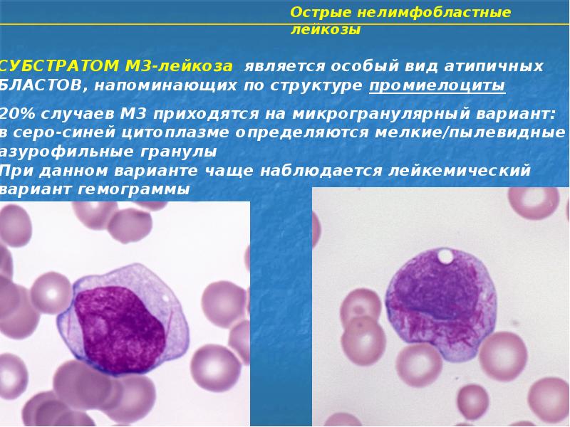 Острый миелолейкоз презентация