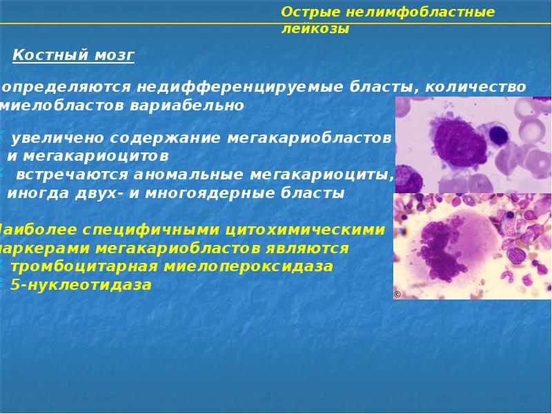 Острый недифференцированный лейкоз картина крови