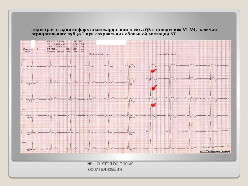 Экг при инфаркте миокарда фото с расшифровкой для студентов