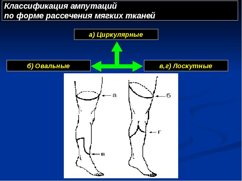 Классификация ампутаций Классификация ампутаций