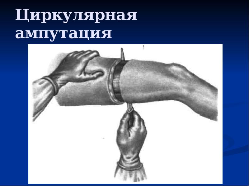 Циркулярная ампутация Циркулярная ампутация