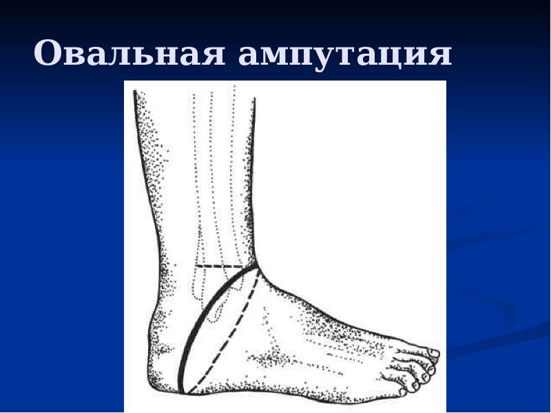 Овальная ампутация Овальная ампутация