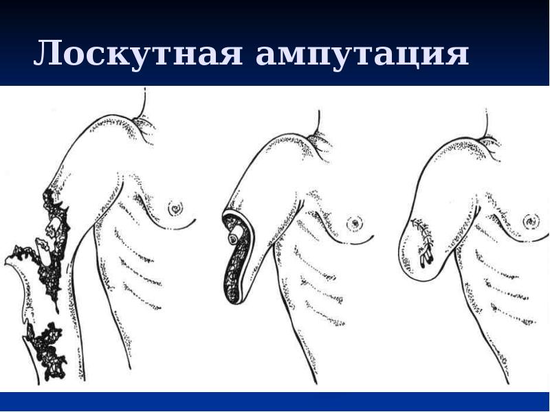 Лоскутная ампутация Лоскутная ампутация