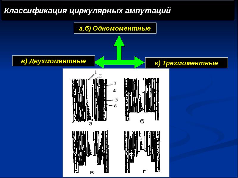Классификация циркулярных ампутаций Классификация циркулярных ампутаций