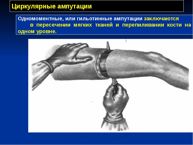 Циркулярные ампутации Циркулярные ампутации