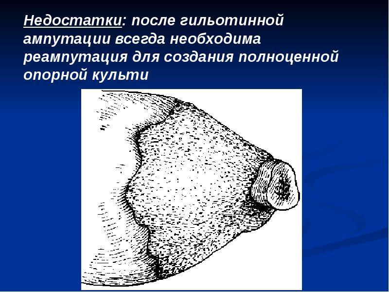 Недостатки: после гильотинной ампутации всегда необходима реампутация для создания полноценной опорной Недостатки: после гильотинной ампутации всегда необходима реампутация для создания полноценной опорной