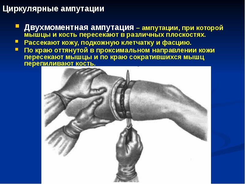 Циркулярные ампутации
Двухмоментная ампутация – ампутации, при которой мышцы и Циркулярные ампутации
Двухмоментная ампутация – ампутации, при которой мышцы и