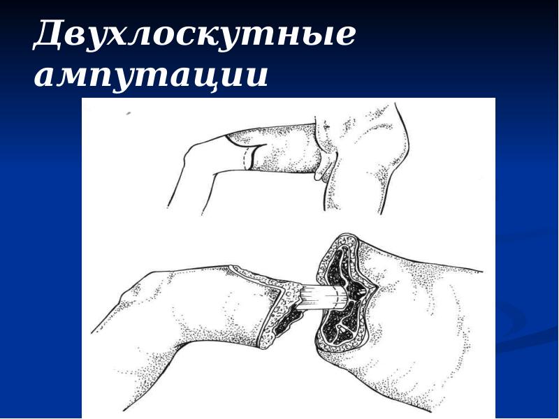 Двухлоскутные ампутации Двухлоскутные ампутации
