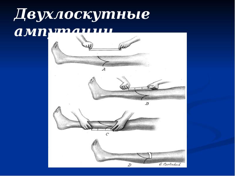 Двухлоскутные ампутации Двухлоскутные ампутации