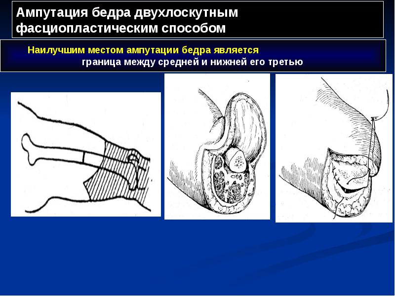 Ампутация бедра двухлоскутным фасциопластическим способом Ампутация бедра двухлоскутным фасциопластическим способом