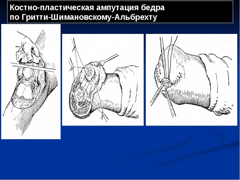 Костно-пластическая ампутация бедра по Гритти-Шимановскому-Альбрехту Костно-пластическая ампутация бедра по Гритти-Шимановскому-Альбрехту