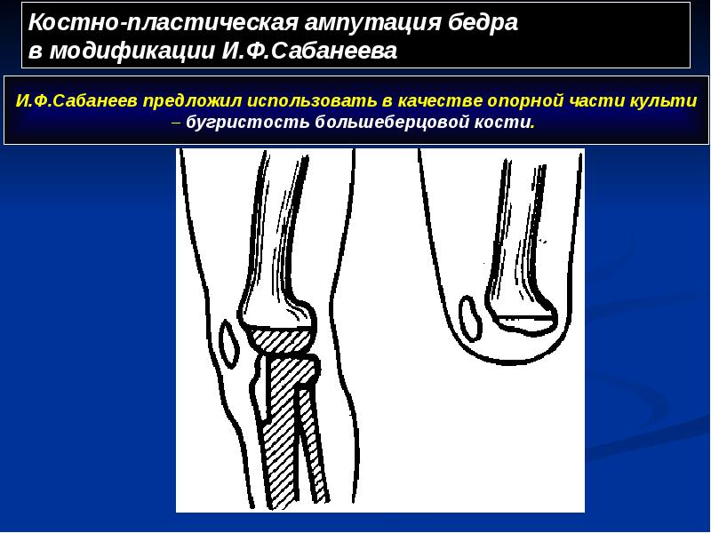 Костно-пластическая ампутация бедра в модификации И.Ф.Сабанеева Костно-пластическая ампутация бедра в модификации И.Ф.Сабанеева