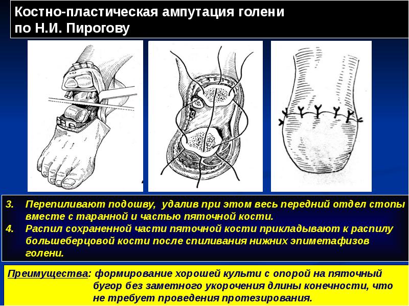 Ампутация предплечья в нижней трети