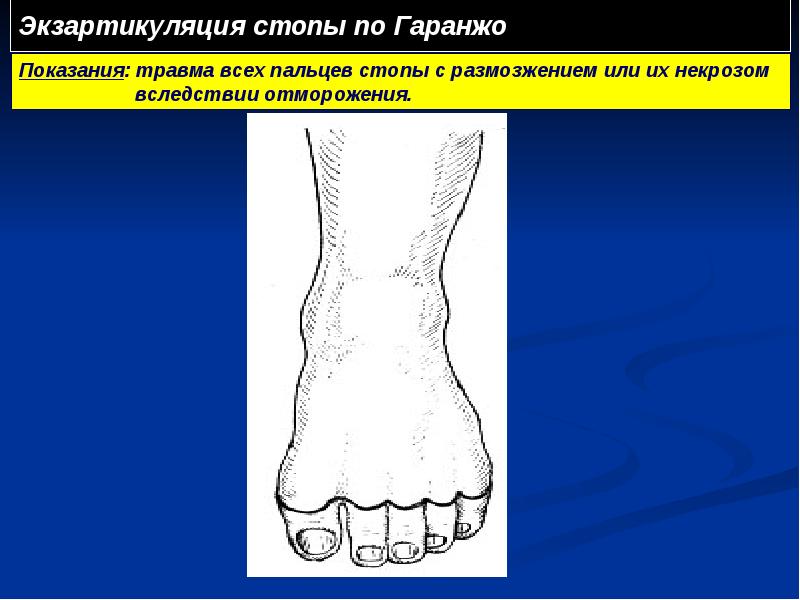 Экзартикуляция стопы по Гаранжо Экзартикуляция стопы по Гаранжо