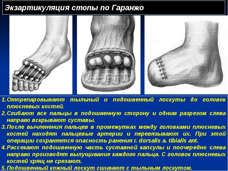 Экзартикуляция стопы по Гаранжо Экзартикуляция стопы по Гаранжо