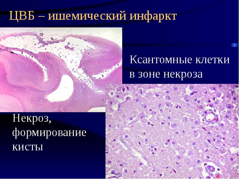 Ибс патологическая анатомия презентация