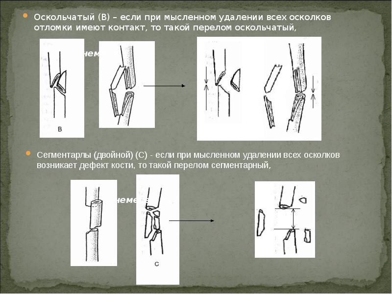 Оскольчатый перелом. Сегментарный перелом оскольчатый. Осколок отломок и фрагмент. Сегментальгве переломы. Оскольчатый и сегментарный перелом разница.