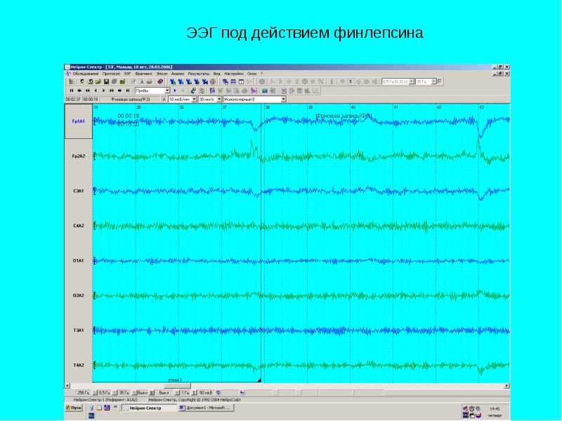 Срок действия электроэнцефалограмма для водителя