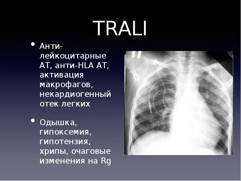 Некардиогенный отек легких презентация