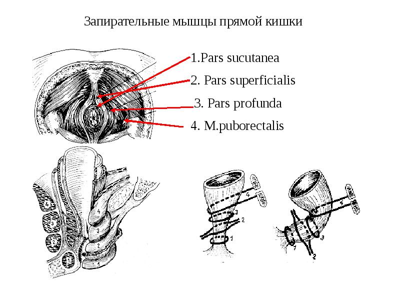 Заболевания прямой кишки факультетская хирургия презентация