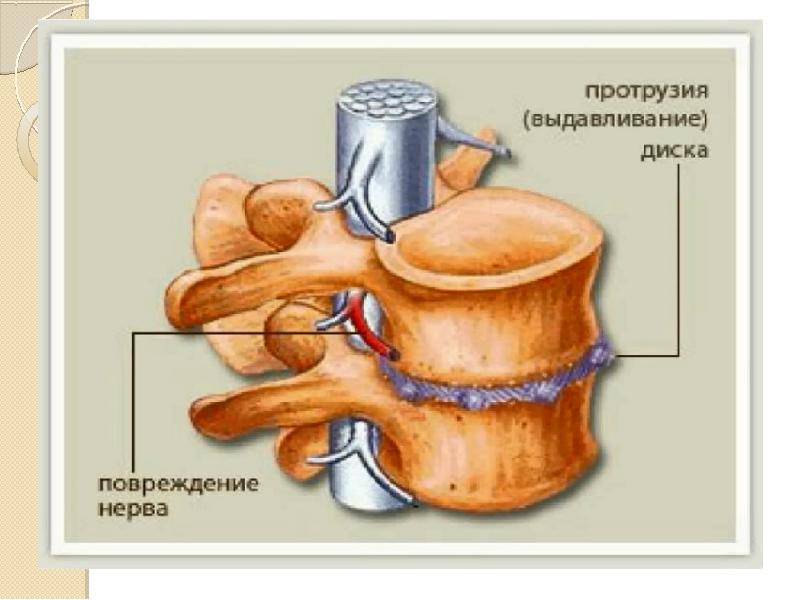 Грыжа межпозвонковых дисков презентация