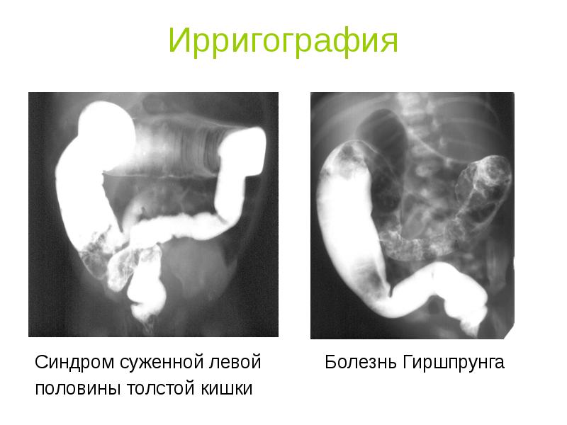 Врожденная низкая кишечная непроходимость презентация