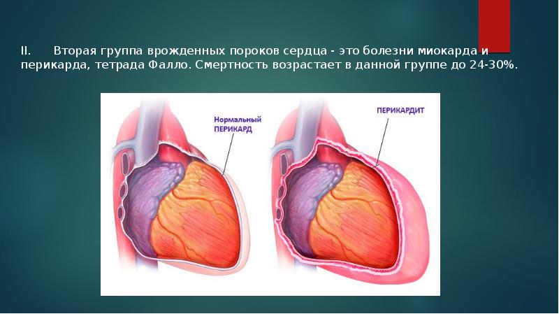 Врожденные пороки развития сердца презентация