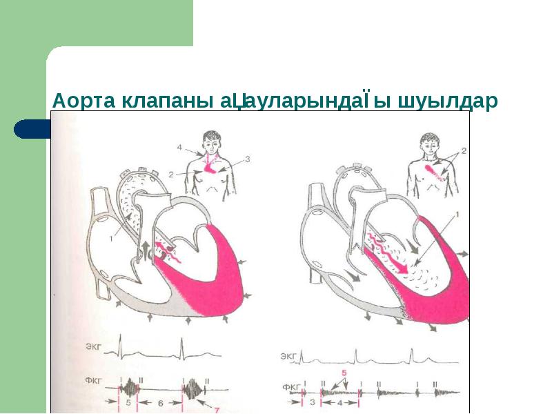 Составляющие клапана аорты. Площадь открытия аортального клапана.