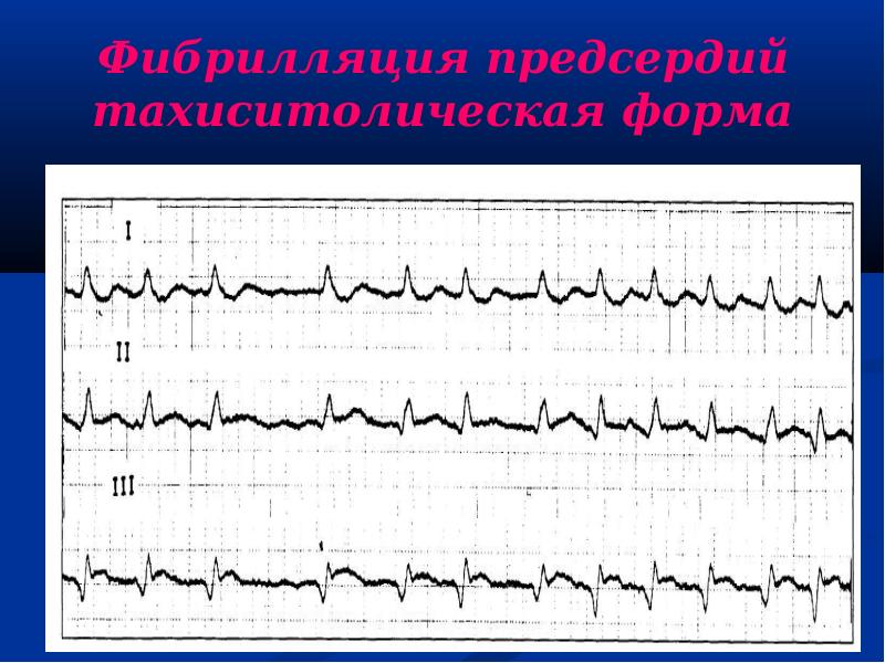 Аритмии презентация факультетская терапия