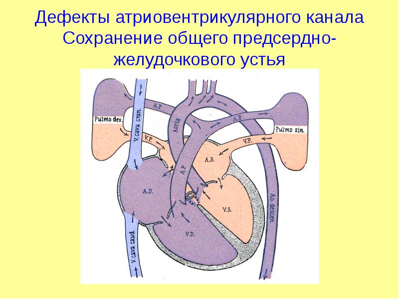 Атрезия трехстворчатого клапана презентация