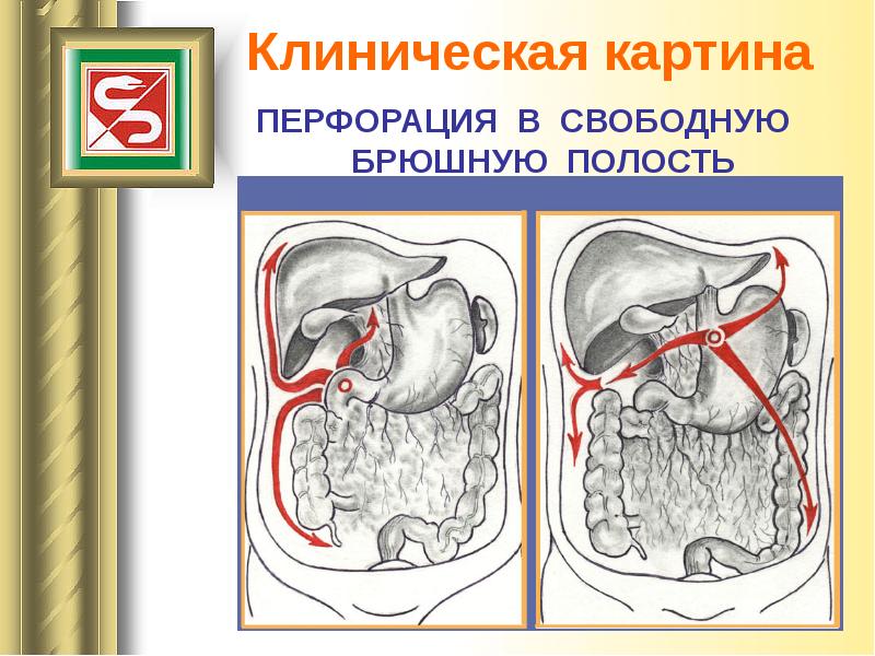 Клиническая картина язвы