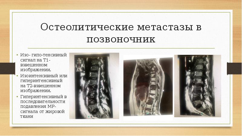 Метастазы в позвоночнике симптомы