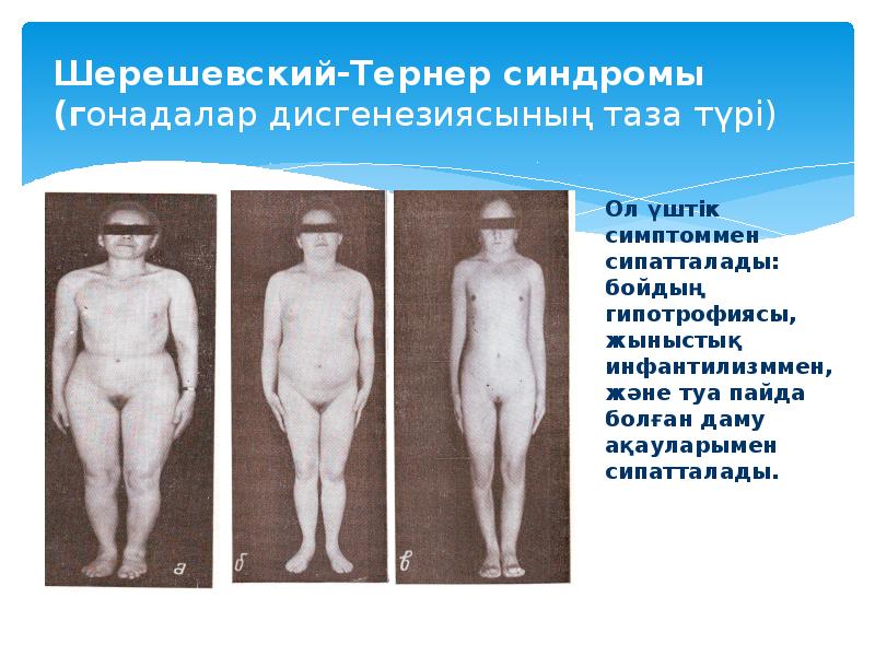 Шерешевский-Тернер синдромы  (гонадалар дисгенезиясының таза түрі)