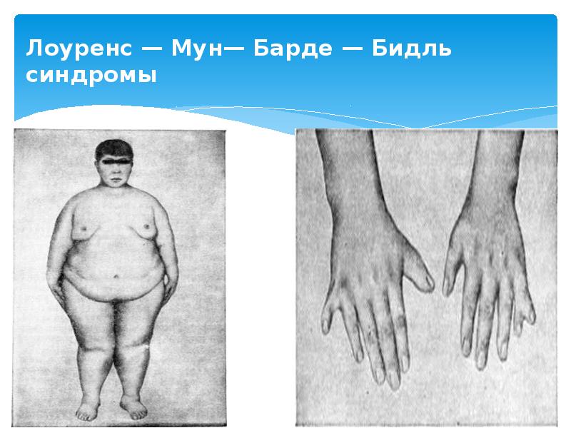 Лоуренс — Мун— Барде — Бидль синдромы