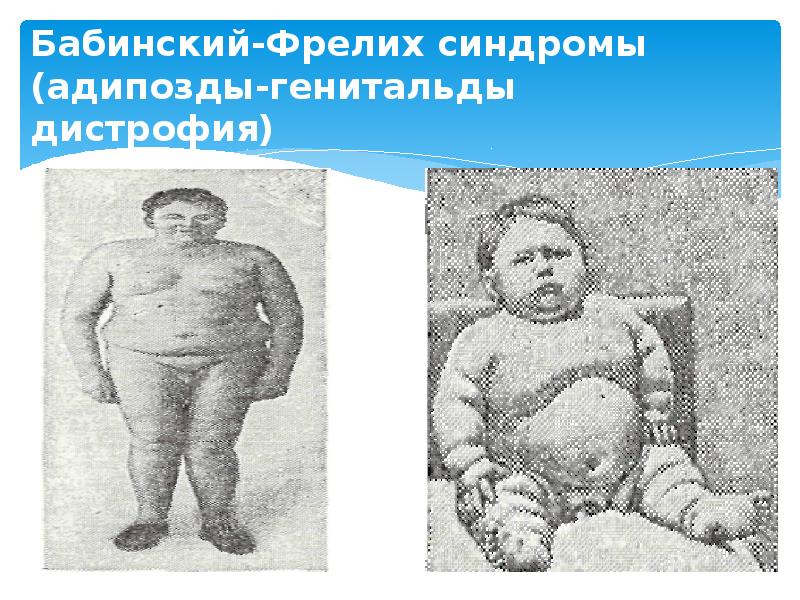 Бабинский-Фрелих синдромы (адипозды-генитальды дистрофия)