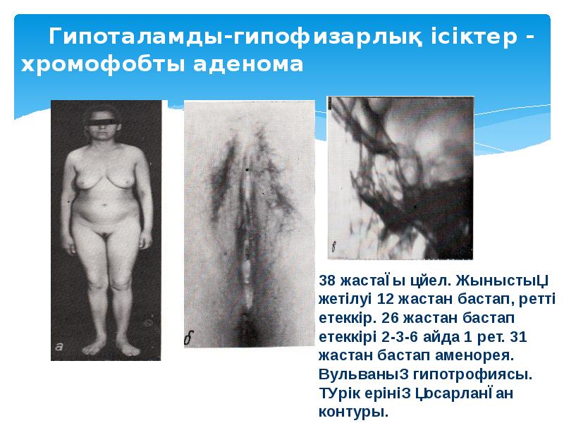 Гипоталамды-гипофизарлық ісіктер - хромофобты аденома