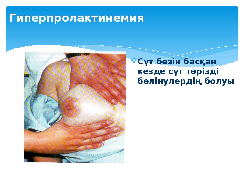 Гиперпролактинемия