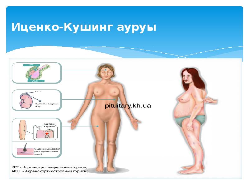 Иценко-Кушинг ауруы