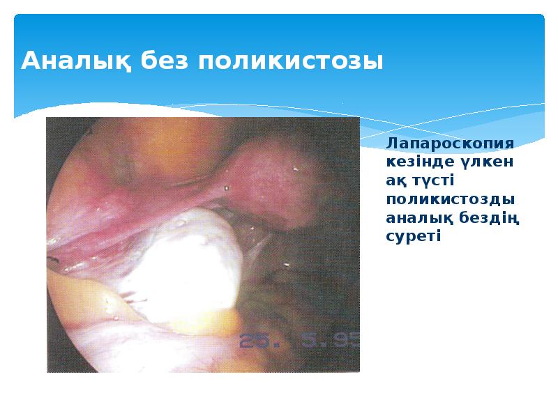 Аналық без поликистозы
