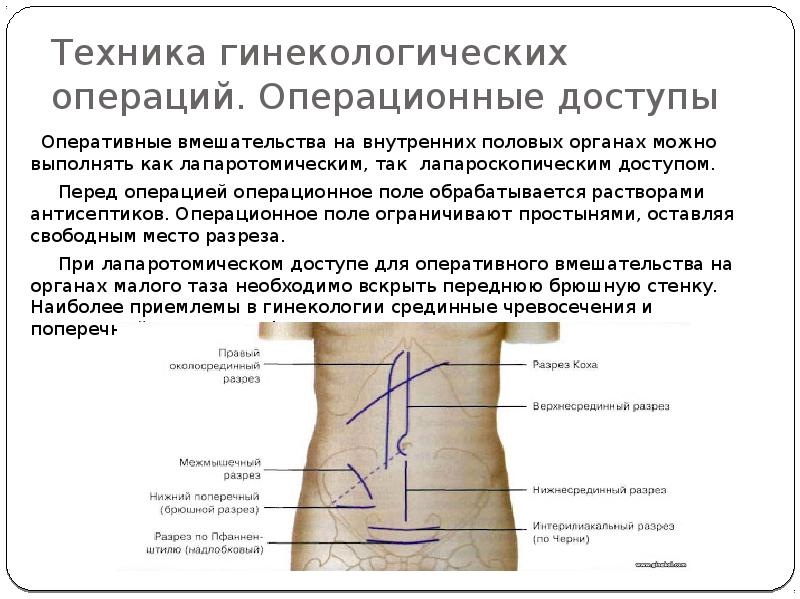 Гинекологические операции презентация